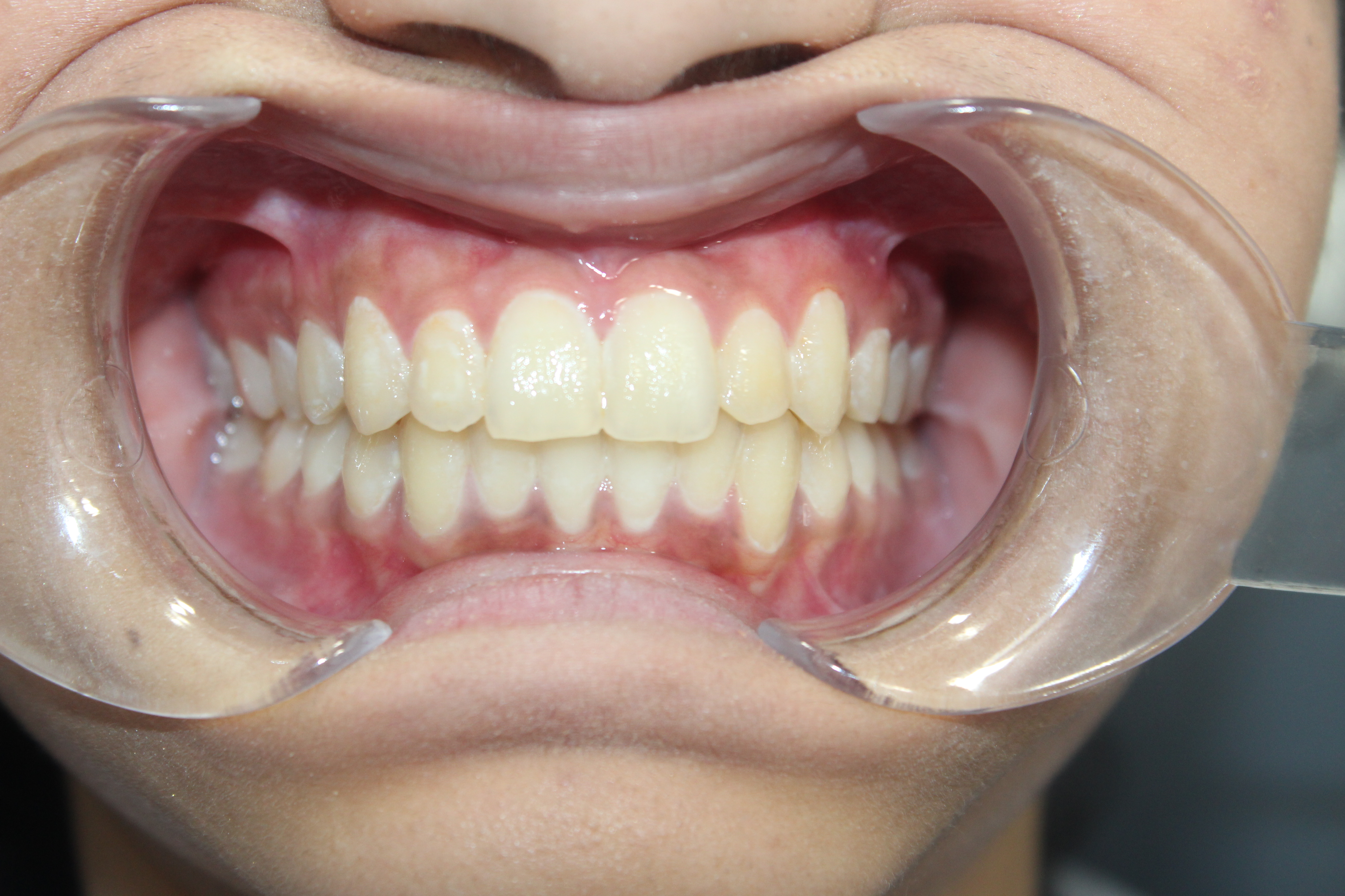 After Invisalign: straightened teeth - White Lotus Dental Frisco TX