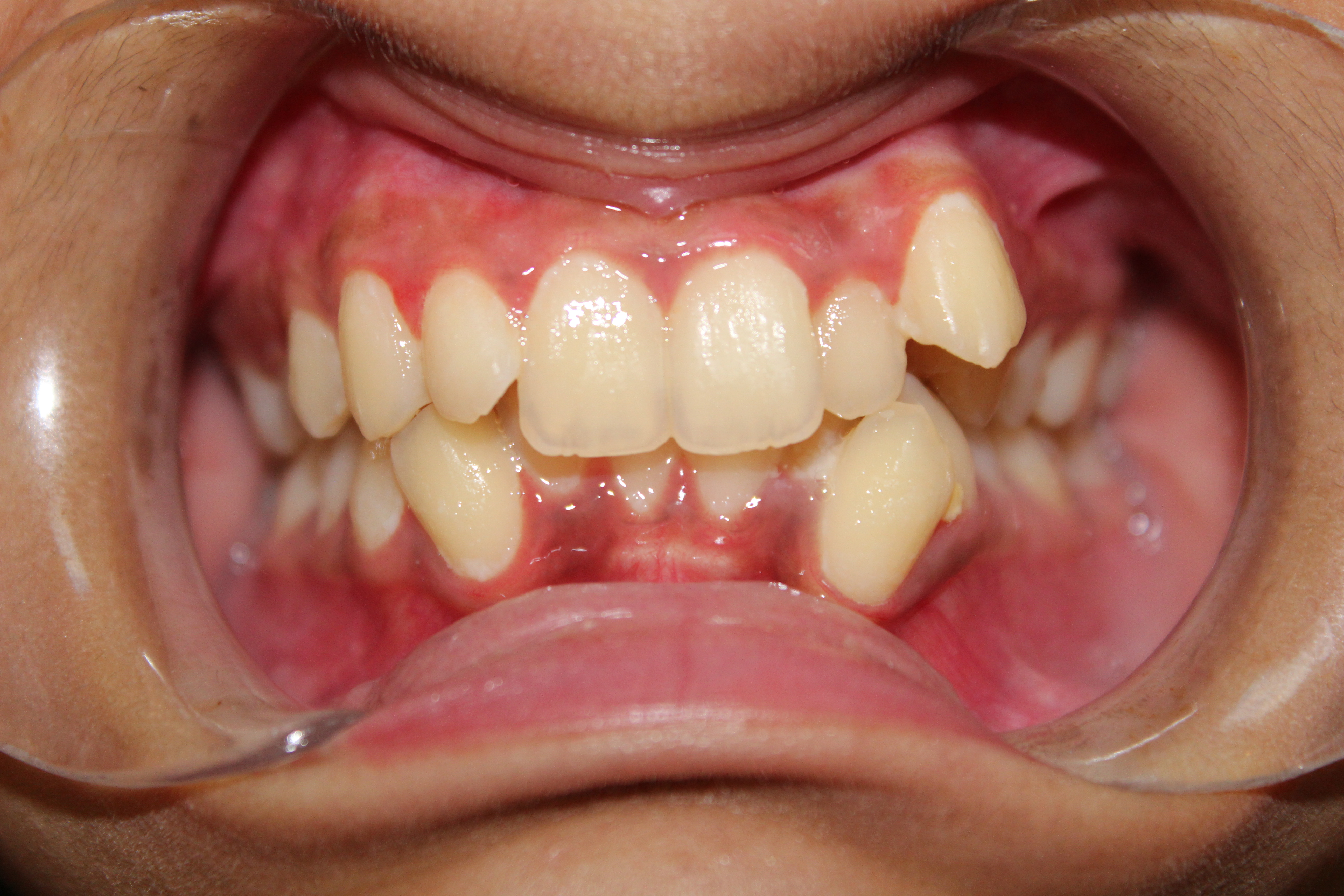 Before Invisalign: crowded teeth - White Lotus Dental Frisco TX