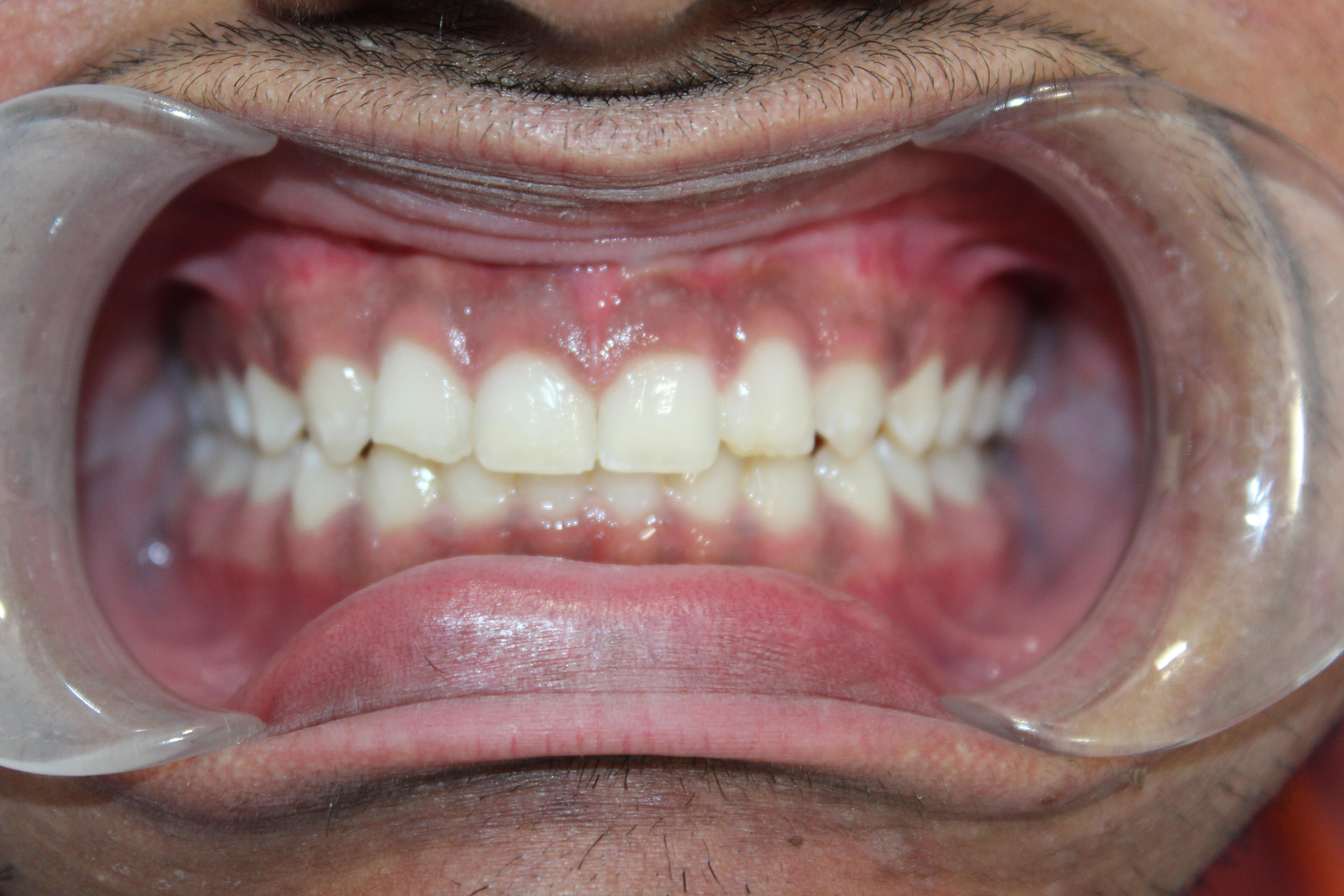 After Invisalign: corrected alignment - White Lotus Dental Frisco TX
