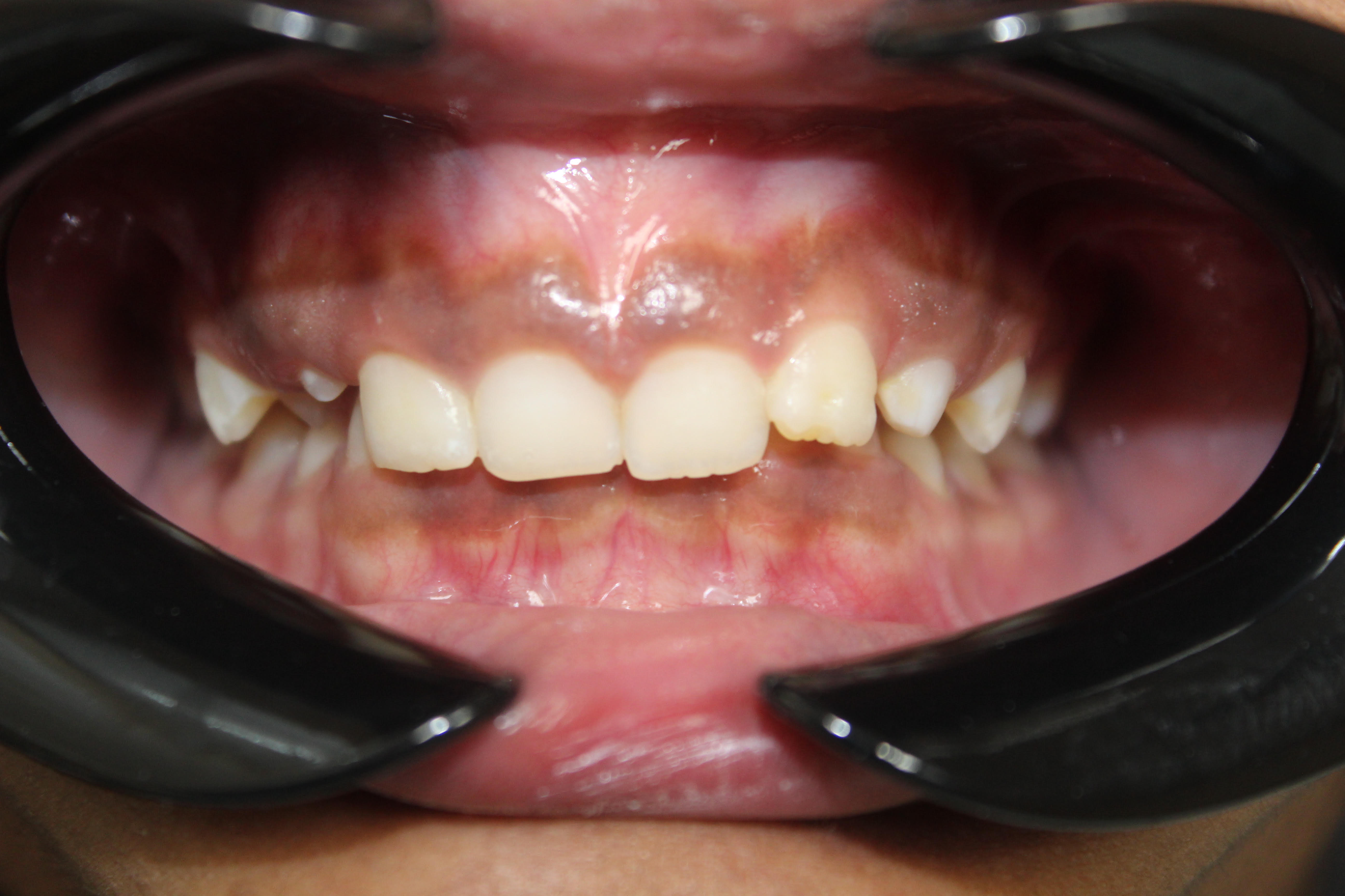 Before Invisalign: uneven bite - White Lotus Dental Frisco TX