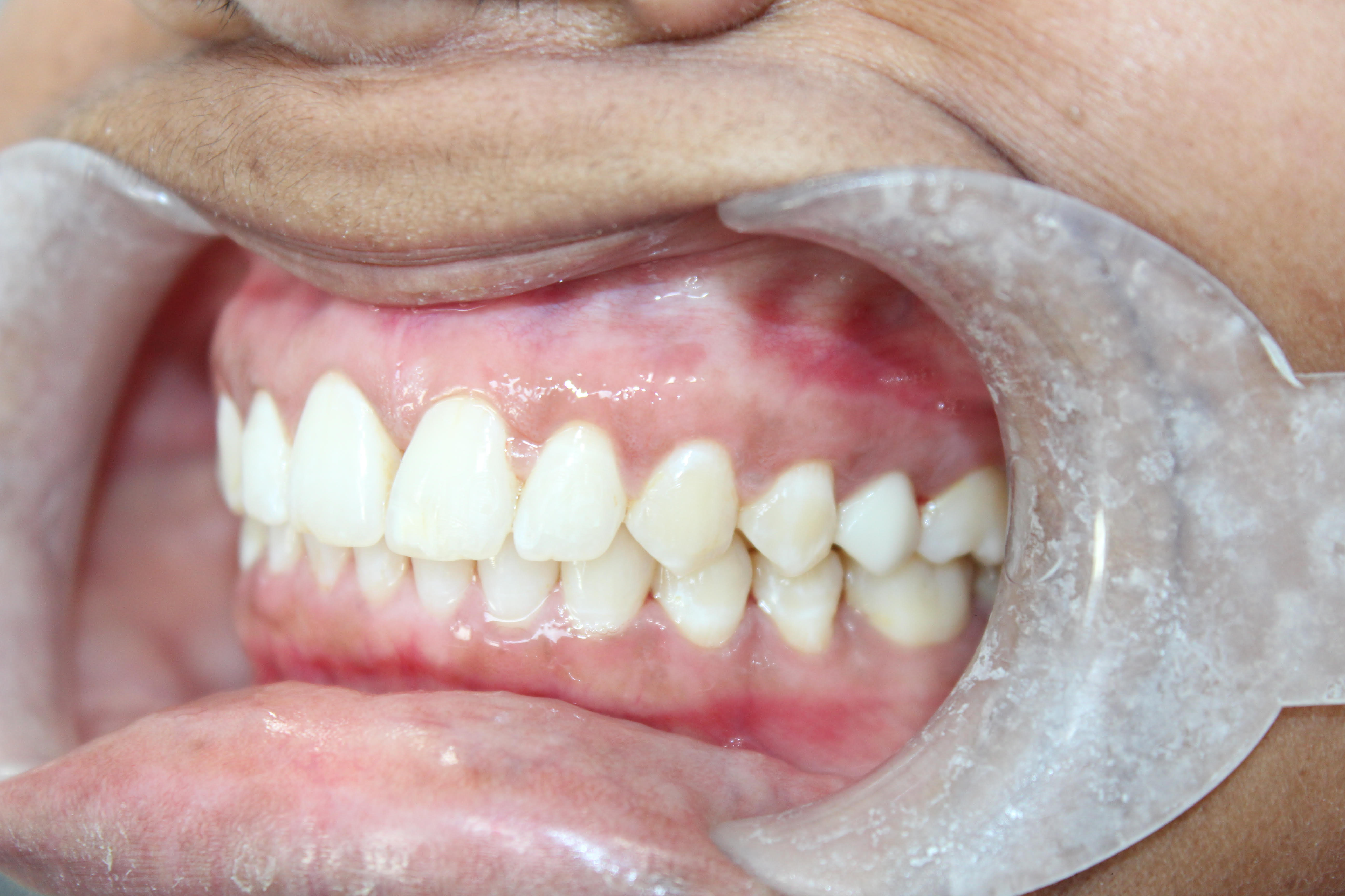 After Invisalign: gap closed - White Lotus Dental Frisco TX