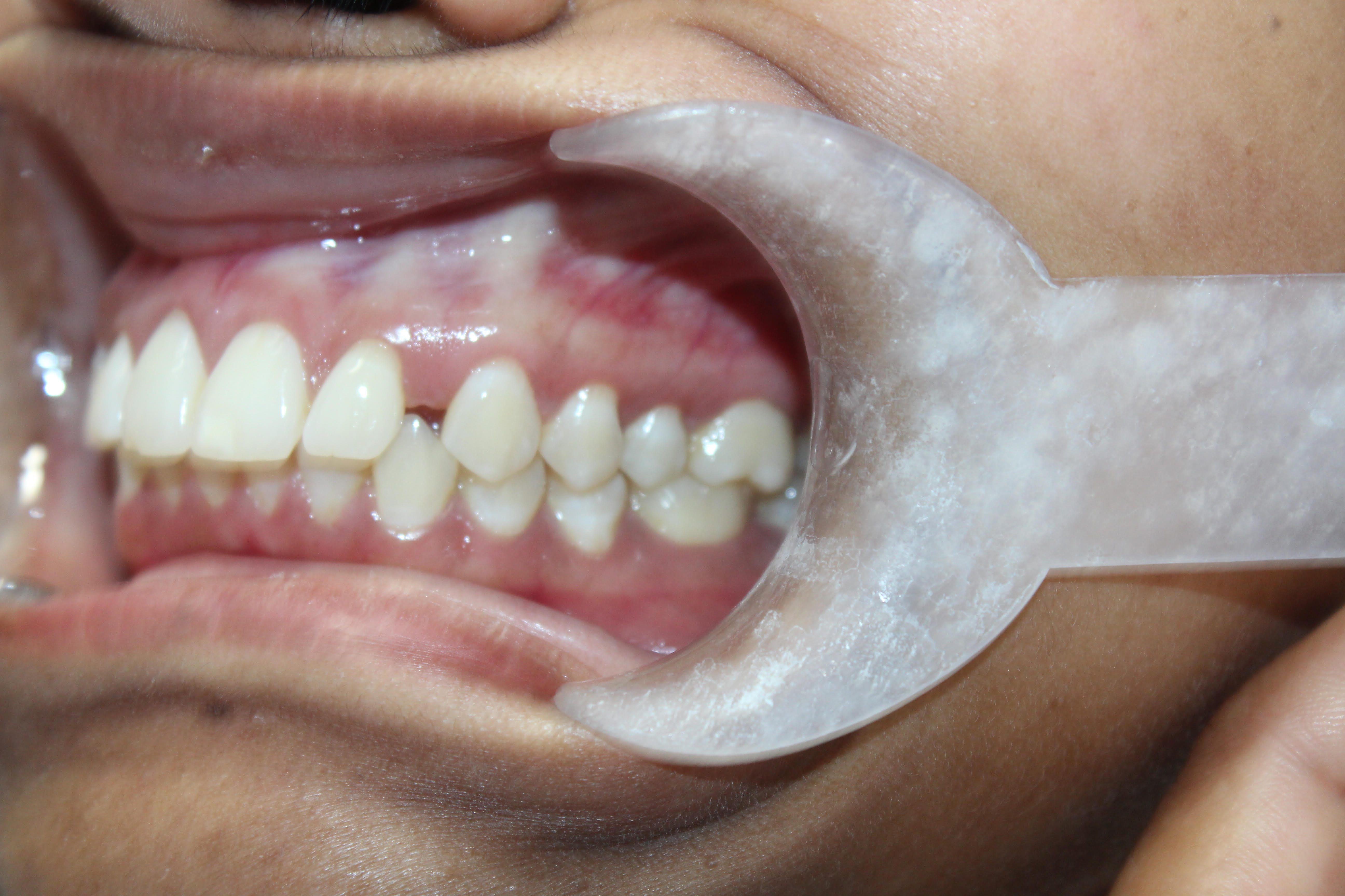 Before Invisalign: spacing gap between teeth - White Lotus Dental Frisco TX